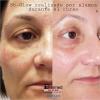 BB Glow - aplicación con dermapen-